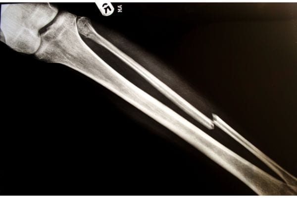 Bone Fracture Injuries » Abrahamson & Uiterwyk Injury Lawyers