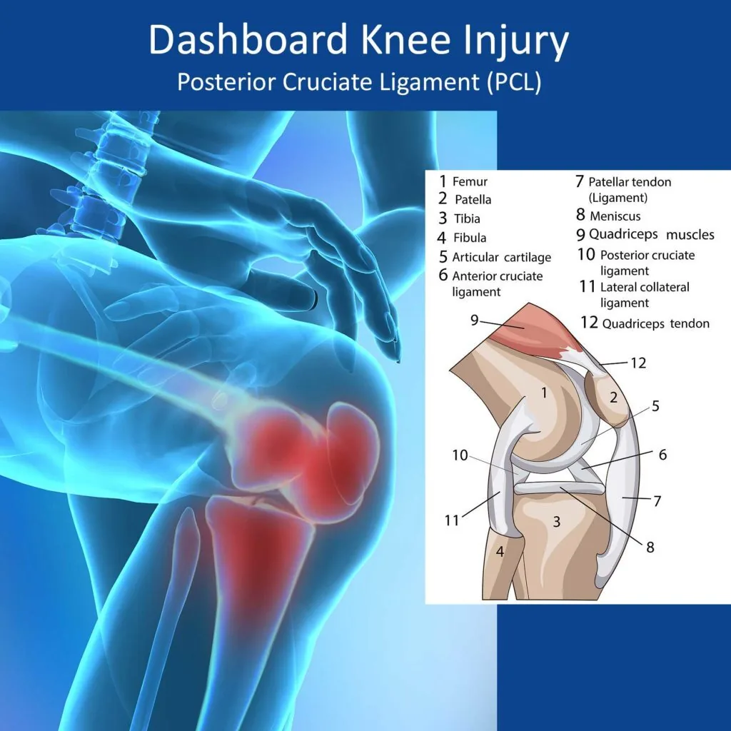 Common Knee Injuries Caused by Car Crashes - Lieser Law Firm